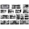 Dental X-Rays