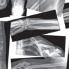 Broken Bones X-Ray Set, Pack of 15