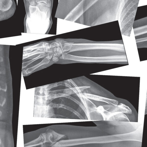 Broken Bones X-Ray Set, Pack of 15